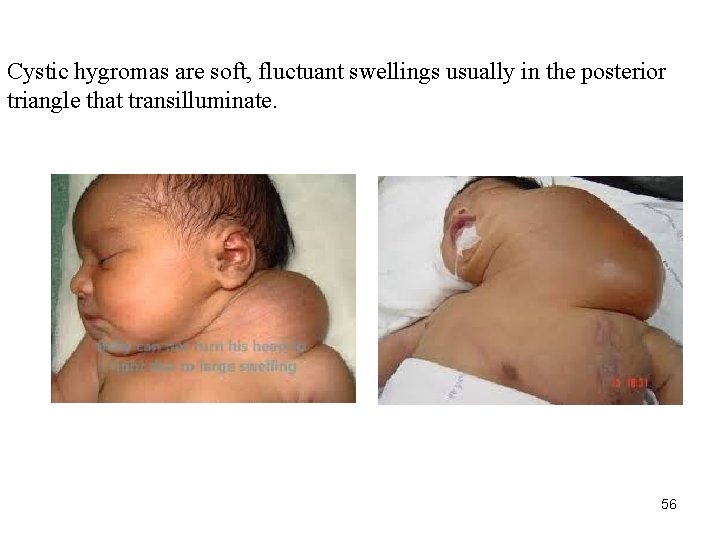 Cystic hygromas are soft, fluctuant swellings usually in the posterior triangle that transilluminate. 56