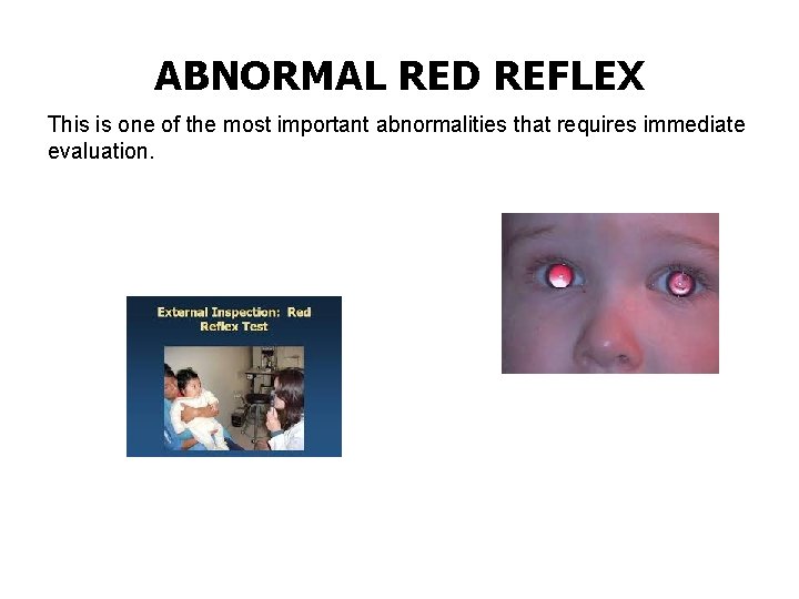 ABNORMAL RED REFLEX This is one of the most important abnormalities that requires immediate