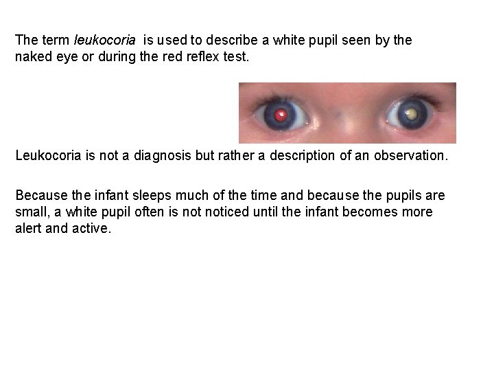 The term leukocoria is used to describe a white pupil seen by the naked