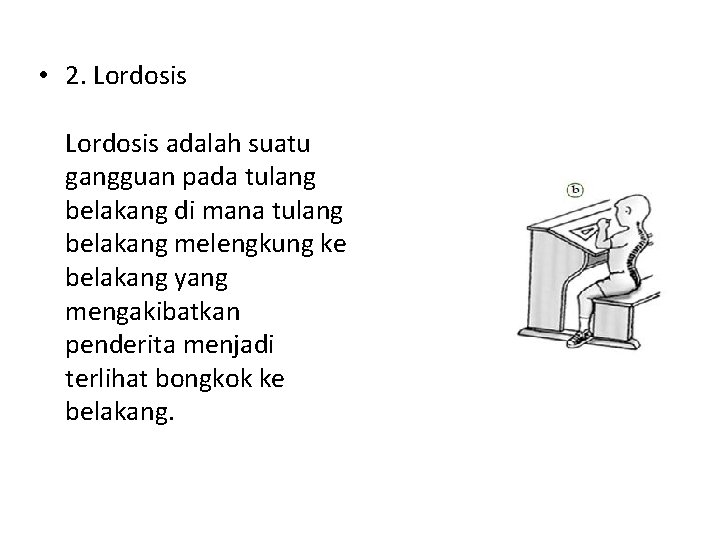  • 2. Lordosis adalah suatu gangguan pada tulang belakang di mana tulang belakang