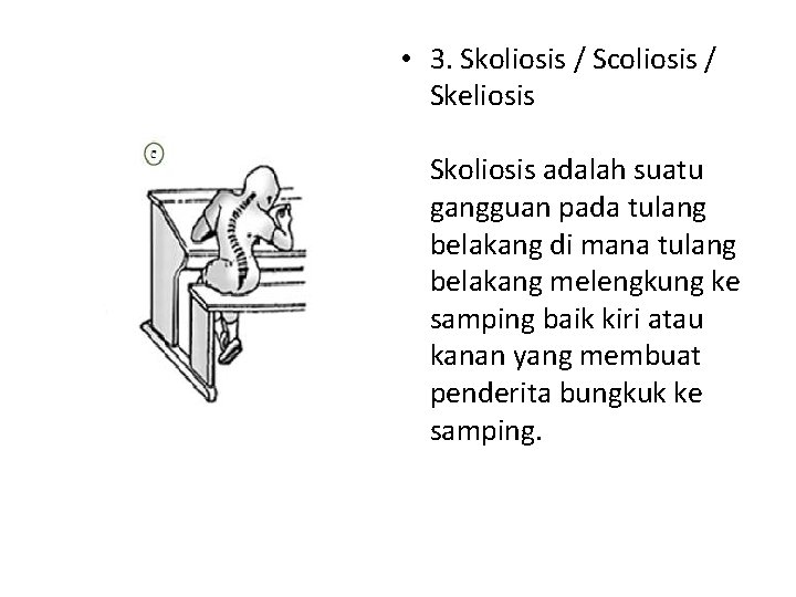 • 3. Skoliosis / Scoliosis / Skeliosis Skoliosis adalah suatu gangguan pada tulang