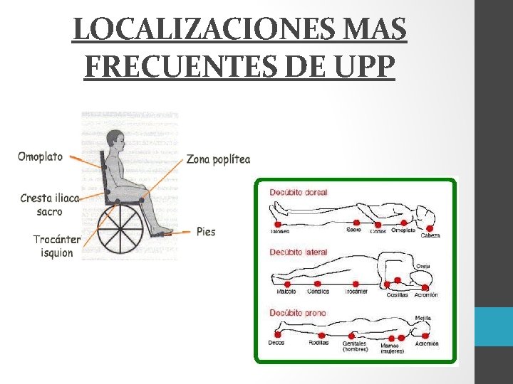 LOCALIZACIONES MAS FRECUENTES DE UPP 