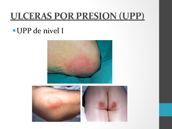 ULCERAS POR PRESION (UPP) § UPP de nivel I 