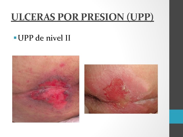 ULCERAS POR PRESION (UPP) § UPP de nivel II 