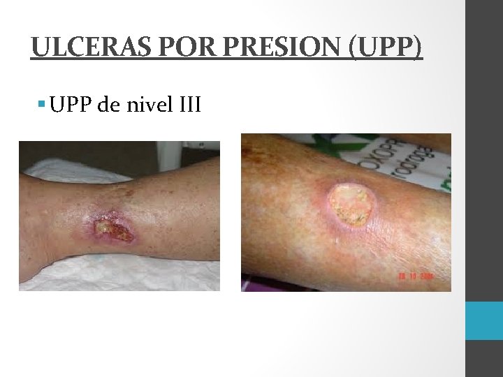 ULCERAS POR PRESION (UPP) § UPP de nivel III 