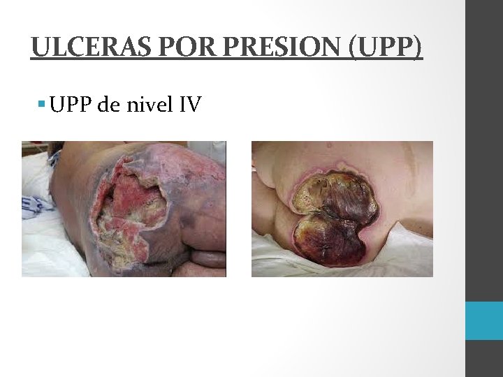 ULCERAS POR PRESION (UPP) § UPP de nivel IV 
