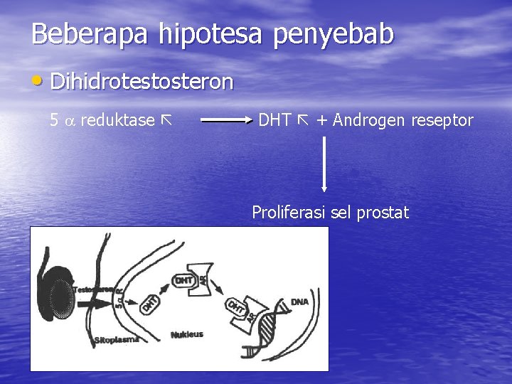 Beberapa hipotesa penyebab • Dihidrotestosteron 5 reduktase DHT + Androgen reseptor Proliferasi sel prostat
