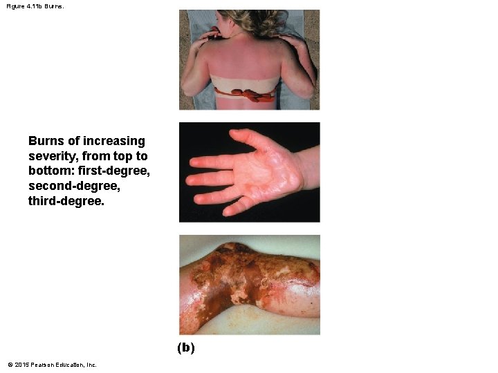 Figure 4. 11 b Burns of increasing severity, from top to bottom: first-degree, second-degree,