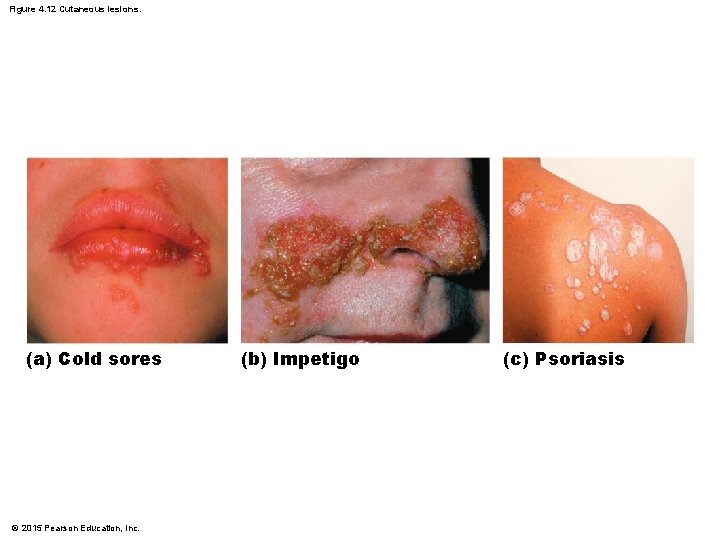 Figure 4. 12 Cutaneous lesions. (a) Cold sores © 2015 Pearson Education, Inc. (b)