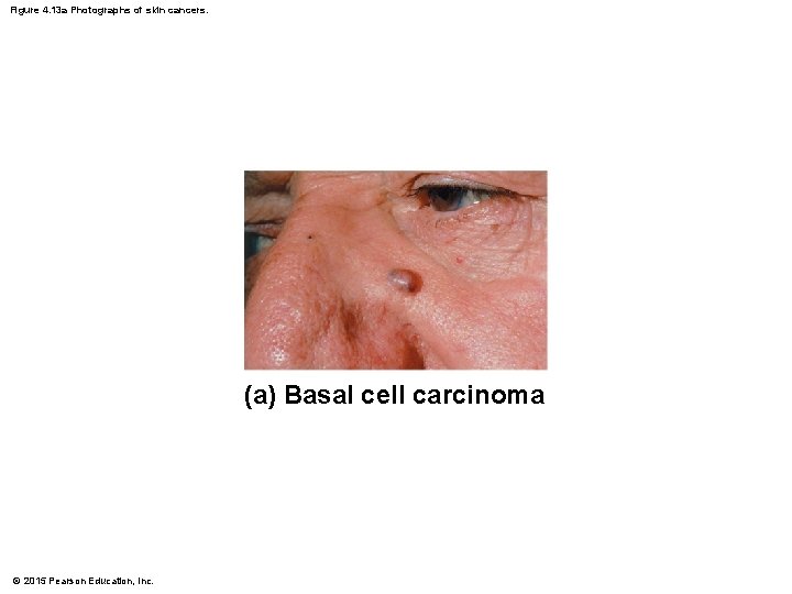 Figure 4. 13 a Photographs of skin cancers. (a) Basal cell carcinoma © 2015