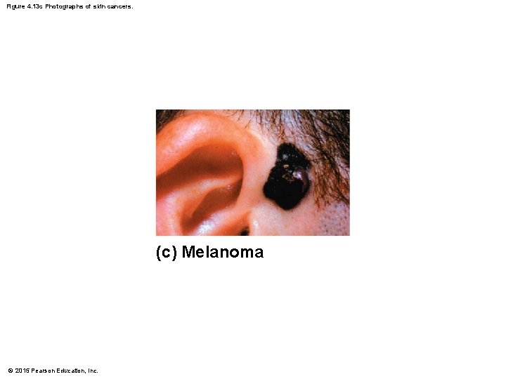 Figure 4. 13 c Photographs of skin cancers. (c) Melanoma © 2015 Pearson Education,