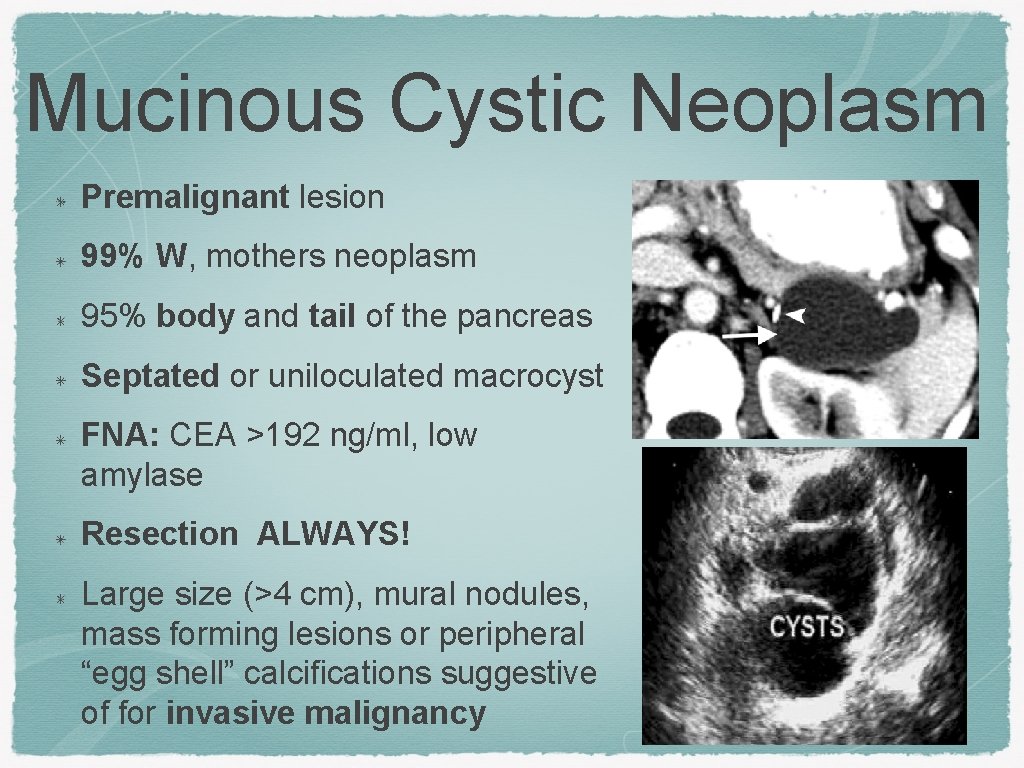 Mucinous Cystic Neoplasm Premalignant lesion 99% W, mothers neoplasm 95% body and tail of