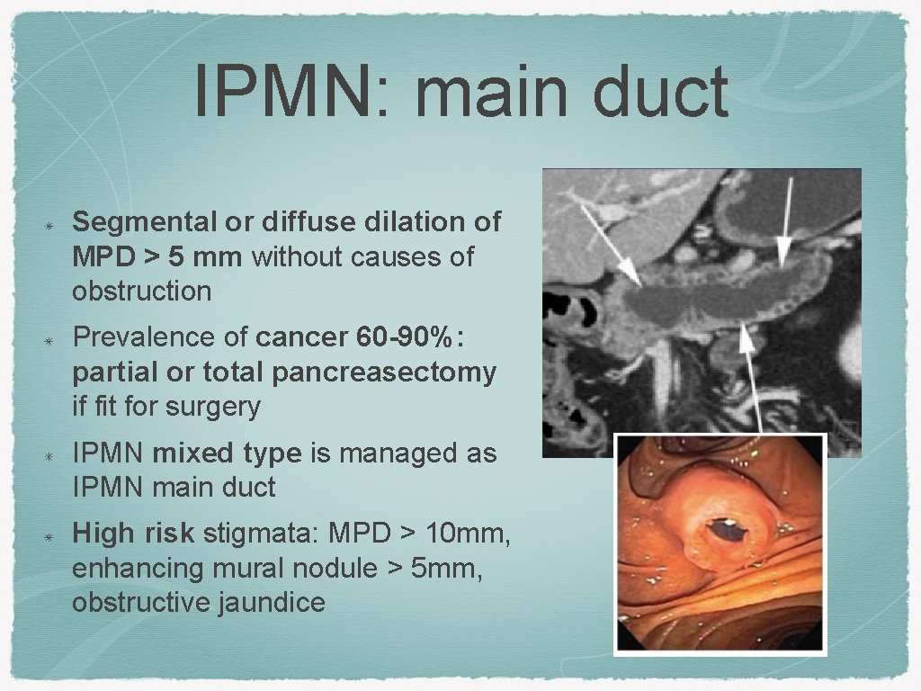 IPMN: main duct Segmental or diffuse dilation of MPD > 5 mm without causes
