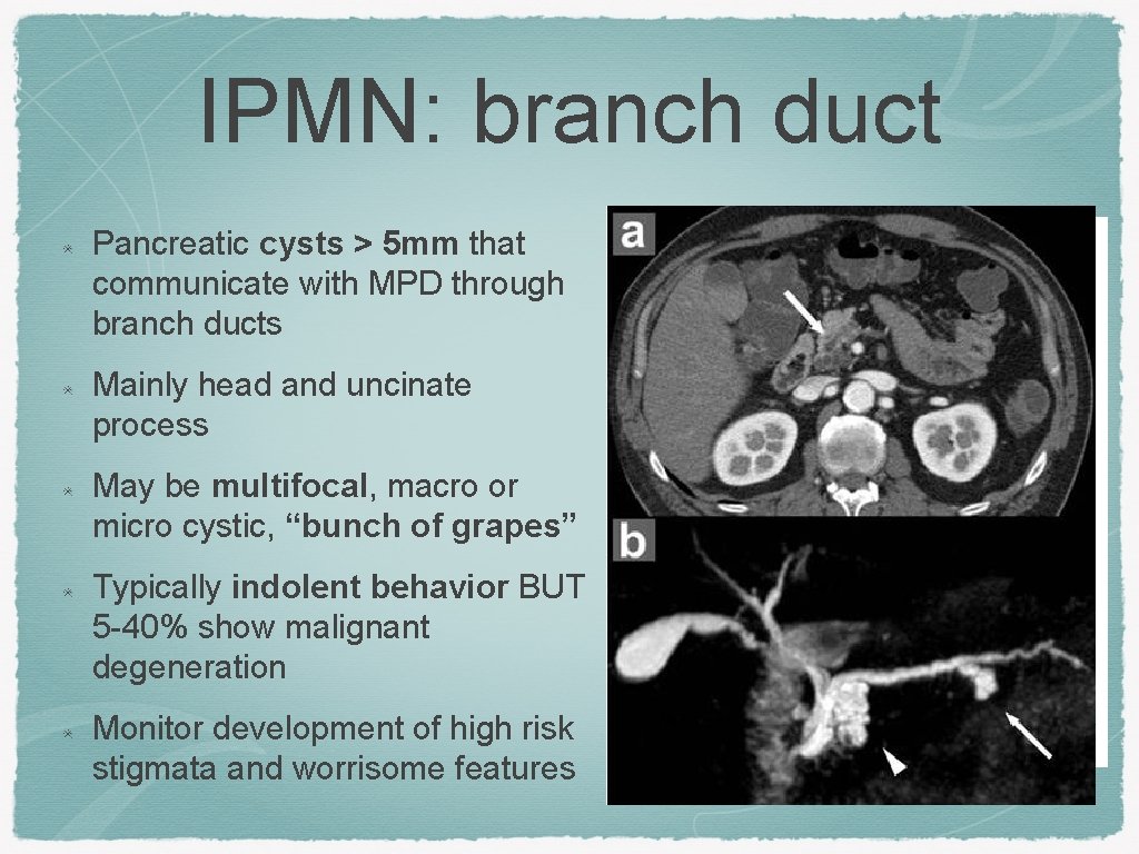 IPMN: branch duct Pancreatic cysts > 5 mm that communicate with MPD through branch