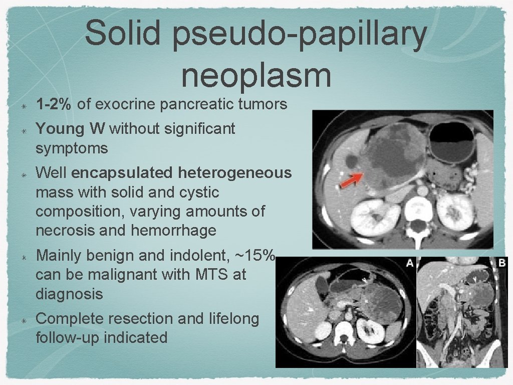 Solid pseudo-papillary neoplasm 1 -2% of exocrine pancreatic tumors Young W without significant symptoms