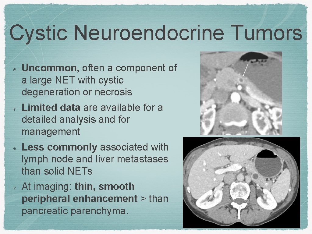 Cystic Neuroendocrine Tumors Uncommon, often a component of a large NET with cystic degeneration