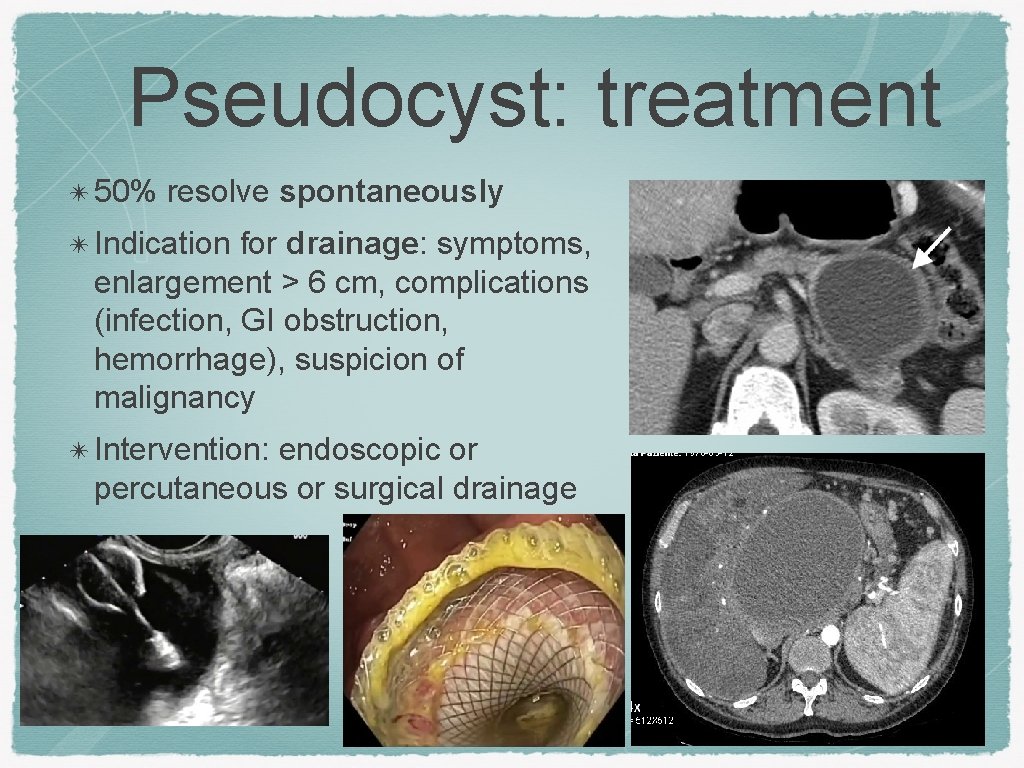 Pseudocyst: treatment ✴ 50% resolve spontaneously ✴ Indication for drainage: symptoms, enlargement > 6