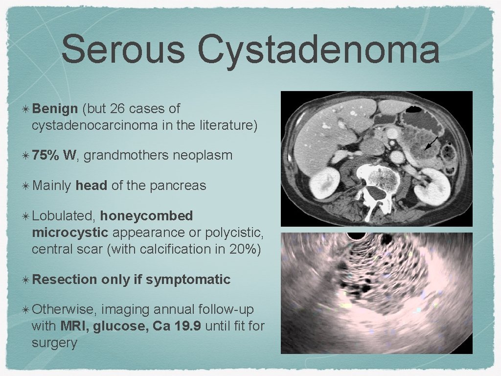 Serous Cystadenoma ✴ Benign (but 26 cases of cystadenocarcinoma in the literature) ✴ 75%