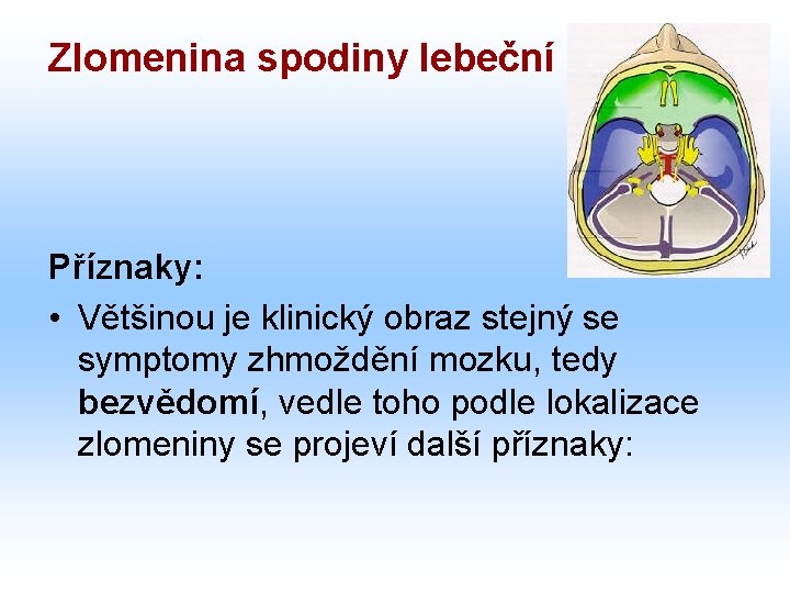 Zlomenina spodiny lebeční Příznaky: • Většinou je klinický obraz stejný se symptomy zhmoždění mozku,