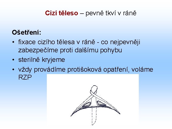 Cizí těleso – pevně tkví v ráně Ošetření: • fixace cizího tělesa v ráně