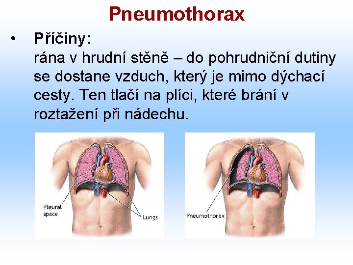 Pneumothorax • Příčiny: rána v hrudní stěně – do pohrudniční dutiny se dostane vzduch,