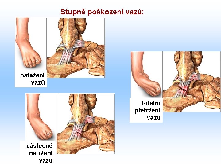 Stupně poškození vazů: natažení vazů totální přetržení vazů částečné natržení vazů 