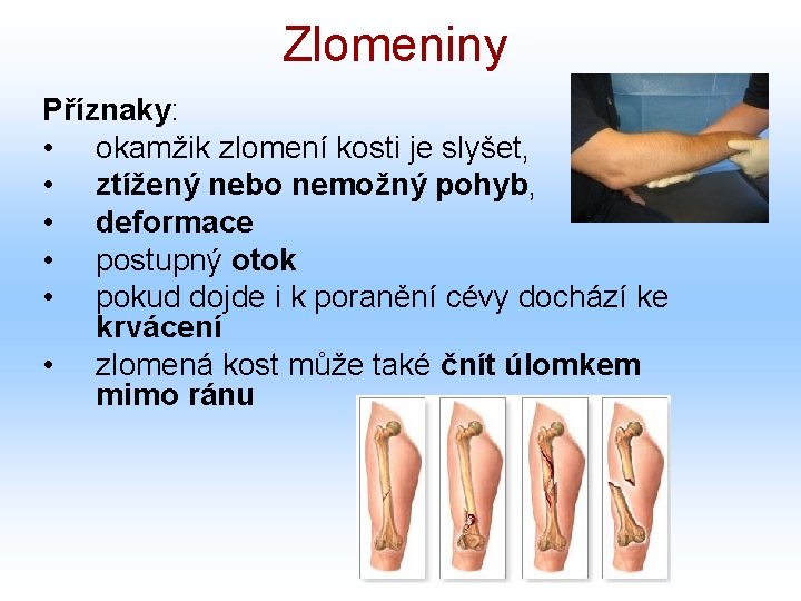 Zlomeniny Příznaky: • okamžik zlomení kosti je slyšet, • ztížený nebo nemožný pohyb, •