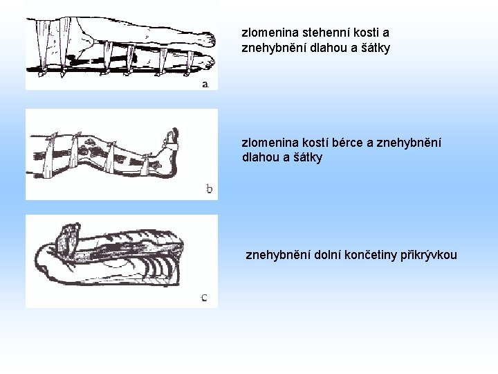 zlomenina stehenní kosti a znehybnění dlahou a šátky zlomenina kostí bérce a znehybnění dlahou