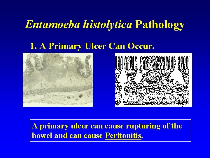 Entamoeba histolytica Pathology 1. A Primary Ulcer Can Occur. A primary ulcer can cause