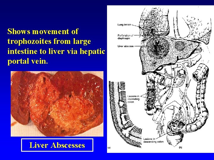 Shows movement of trophozoites from large intestine to liver via hepatic portal vein. Liver