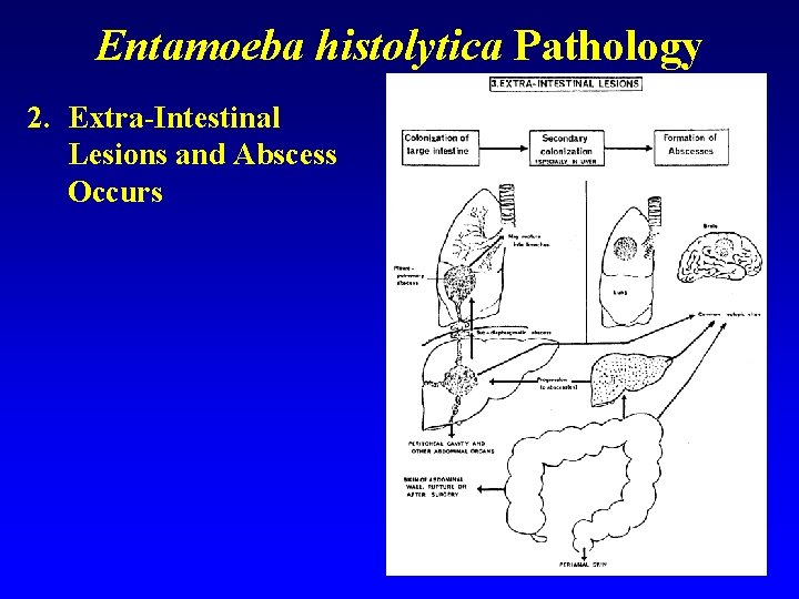 Entamoeba histolytica Pathology 2. Extra-Intestinal Lesions and Abscess Occurs 