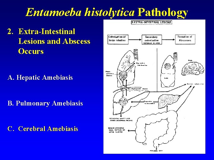 Entamoeba histolytica Pathology 2. Extra-Intestinal Lesions and Abscess Occurs A. Hepatic Amebiasis B. Pulmonary