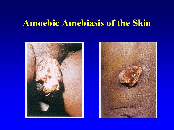 Amoebic Amebiasis of the Skin 