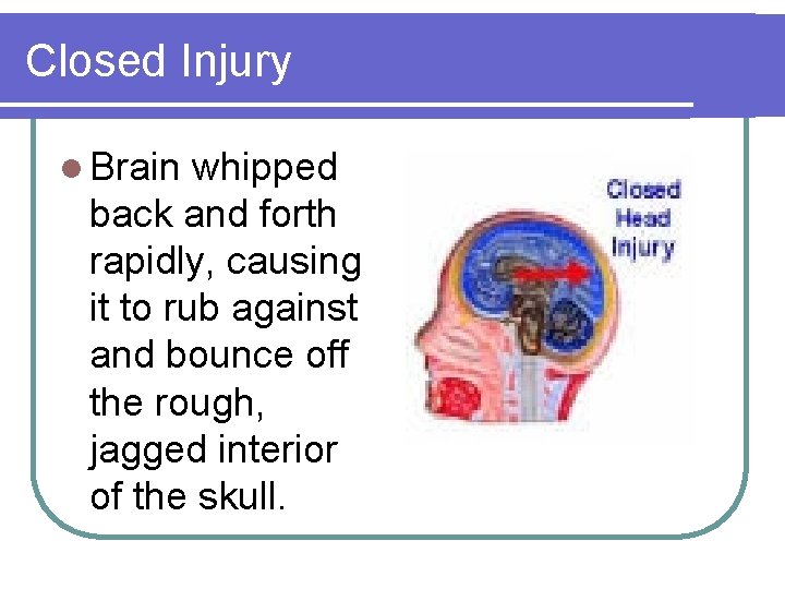 Closed Injury l Brain whipped back and forth rapidly, causing it to rub against