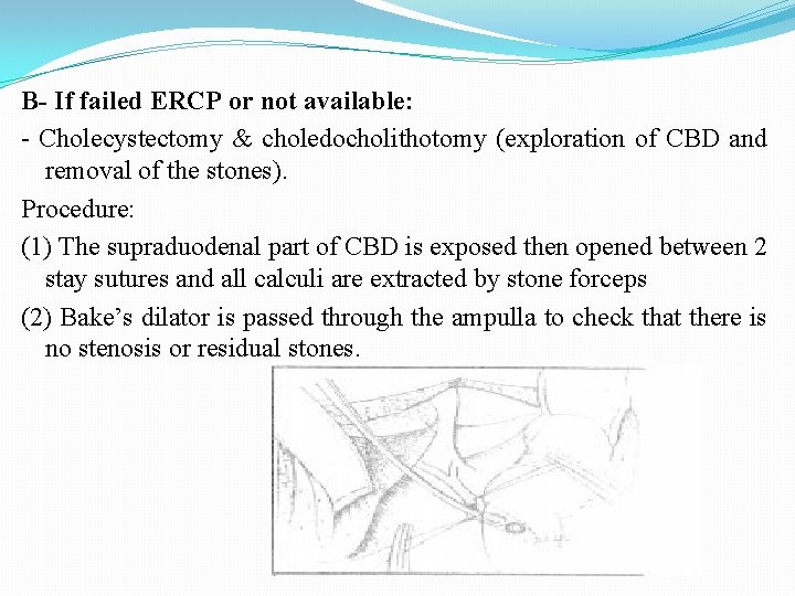 B- If failed ERCP or not available: - Cholecystectomy & choledocholithotomy (exploration of CBD