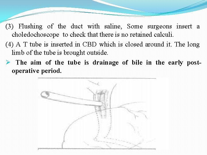 (3) Flushing of the duct with saline, Some surgeons insert a choledochoscope to check