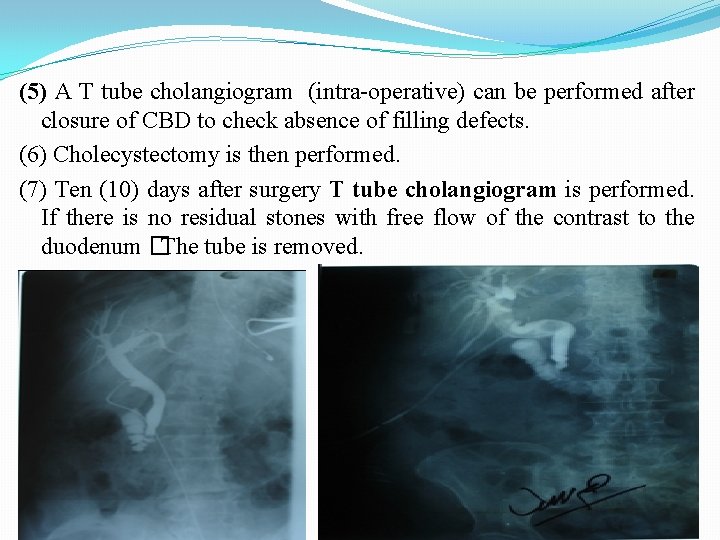 (5) A T tube cholangiogram (intra-operative) can be performed after closure of CBD to