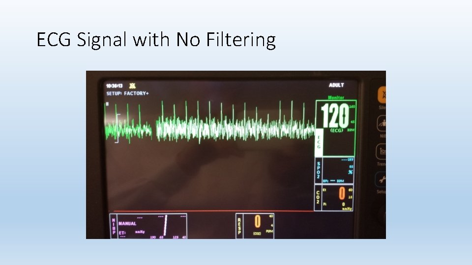 ECG Signal with No Filtering 