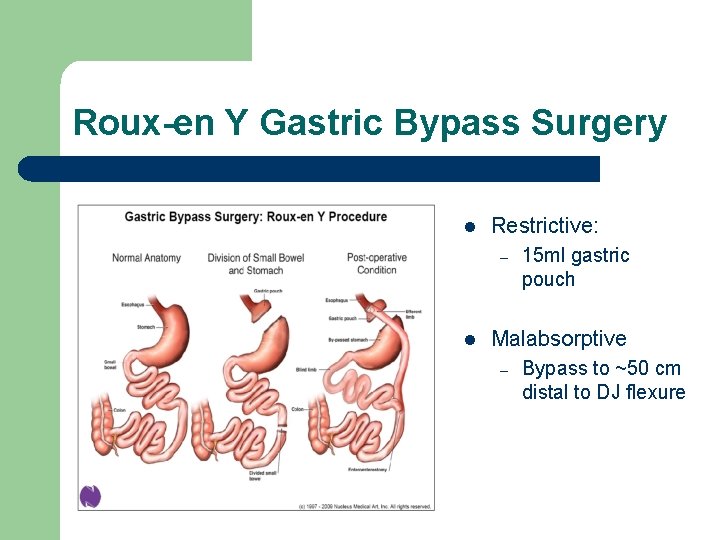 Roux-en Y Gastric Bypass Surgery l Restrictive: – l 15 ml gastric pouch Malabsorptive