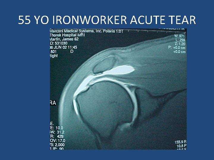 55 YO IRONWORKER ACUTE TEAR 