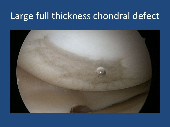 Large full thickness chondral defect 