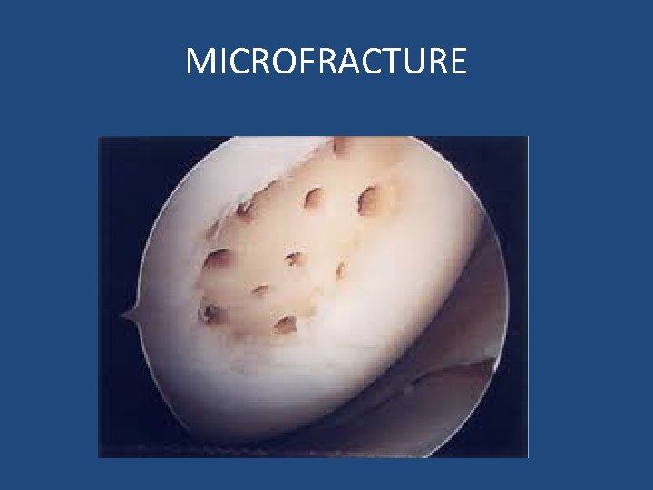 MICROFRACTURE 