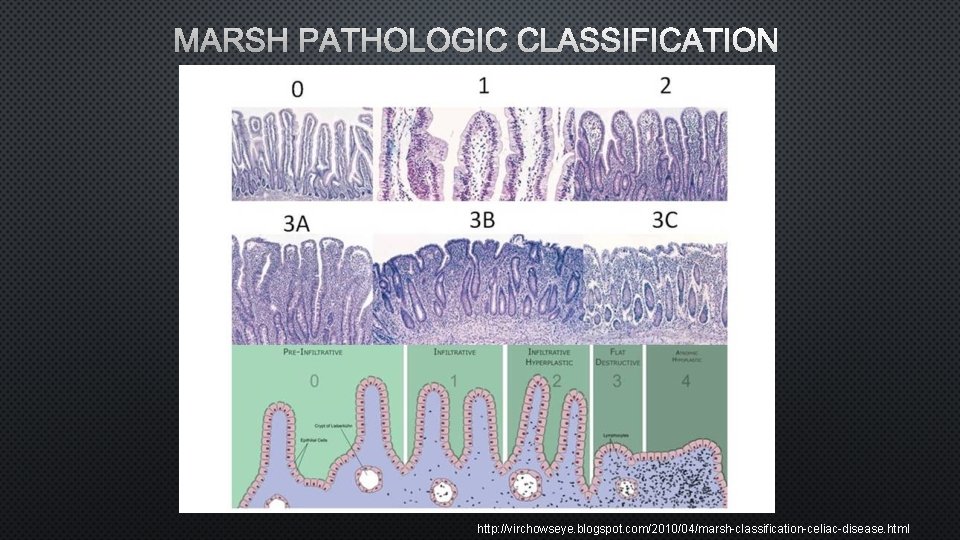 MARSH PATHOLOGIC CLASSIFICATION http: //virchowseye. blogspot. com/2010/04/marsh-classification-celiac-disease. html 