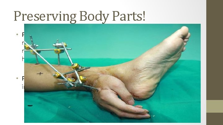 Preserving Body Parts! • Parts without muscles such as fingers can be preserved for