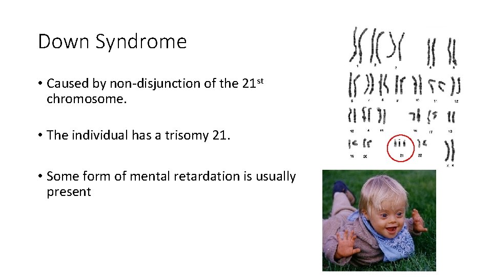 Down Syndrome • Caused by non-disjunction of the 21 st chromosome. • The individual