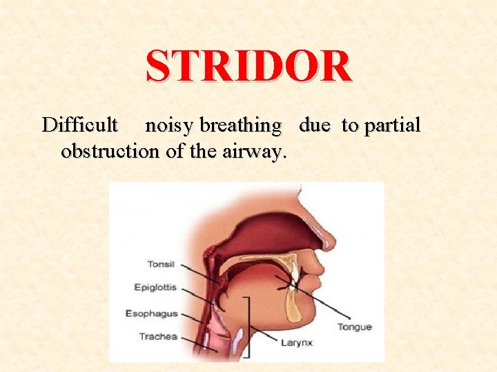 STRIDOR Difficult noisy breathing due to partial obstruction of the airway. 