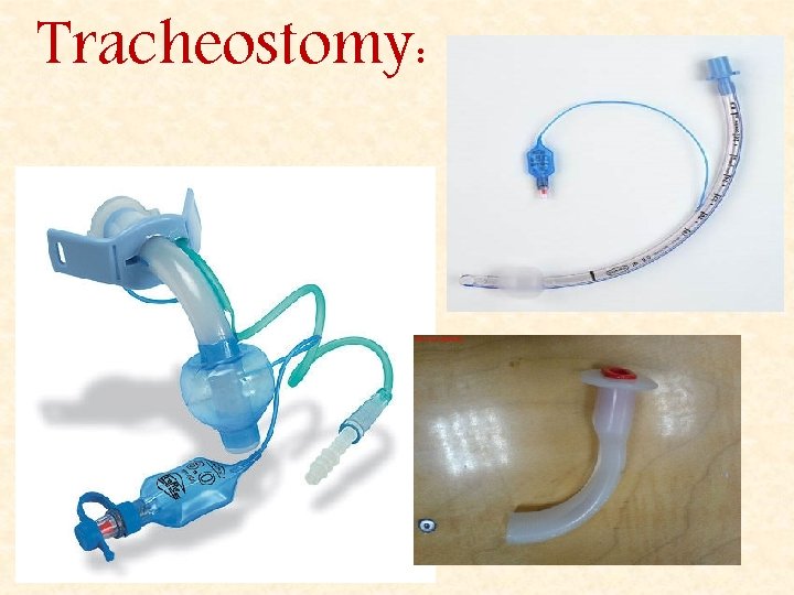 Tracheostomy: 