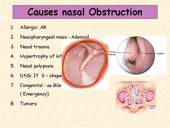 Causes nasal Obstruction 1. Allergic: AR 2. Nasopharyngeal mass : Adenoid. 3. Nasal trauma.