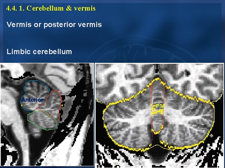 4. 4. 1. Cerebellum & vermis Vermis or posterior vermis Limbic cerebellum Anterior 4. 4. 1. Cerebellum & vermis Vermis or posterior vermis Limbic cerebellum Anterior