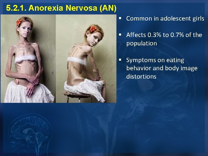 5. 2. 1. Anorexia Nervosa (AN) § Common in adolescent girls § Affects 0.